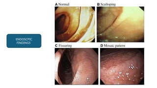 ENDOSCPIC
FINDINGS
 