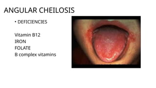 ANGULAR CHEILOSIS
• DEFICIENCIES
Vitamin B12
IRON
FOLATE
B complex vitamins
 