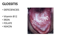 GLOSSITIS
• DEFICIENCIES
• Vitamin B12
• IRON
• FOLATE
• NIACIN
 