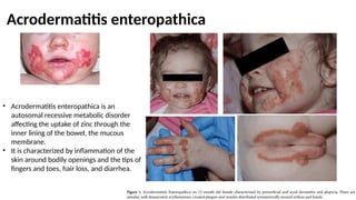 Acrodermatitis enteropathica
• Acrodermatitis enteropathica is an
autosomal recessive metabolic disorder
affecting the uptake of zinc through the
inner lining of the bowel, the mucous
membrane.
• It is characterized by inflammation of the
skin around bodily openings and the tips of
fingers and toes, hair loss, and diarrhea.
 
