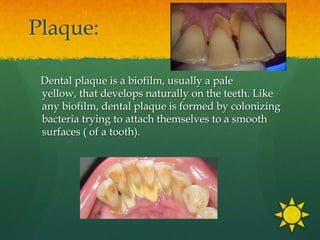 Plaque:

 Dental plaque is a biofilm, usually a pale
 yellow, that develops naturally on the teeth. Like
 any biofilm, dental plaque is formed by colonizing
 bacteria trying to attach themselves to a smooth
 surfaces ( of a tooth).
 