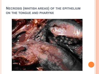 NECROSIS (WHITISH AREAS) OF THE EPITHELIUM
ON THE TONGUE AND PHARYNX
 
