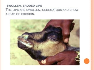 SWOLLEN, ERODED LIPS
THE LIPS ARE SWOLLEN, OEDEMATOUS AND SHOW
AREAS OF EROSION.
 