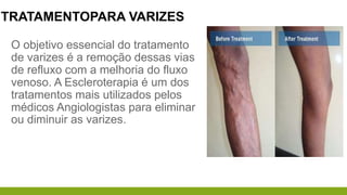 TRATAMENTOPARA VARIZES
O objetivo essencial do tratamento
de varizes é a remoção dessas vias
de refluxo com a melhoria do fluxo
venoso. A Escleroterapia é um dos
tratamentos mais utilizados pelos
médicos Angiologistas para eliminar
ou diminuir as varizes.
 