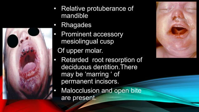 Oral manifestation of syphilis | PPTX
