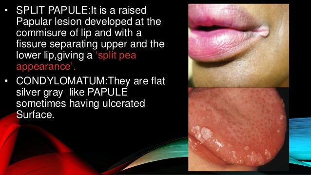 Oral manifestation of syphilis