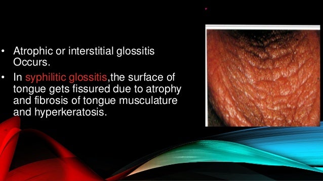 Oral manifestation of syphilis