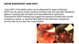 Armorphors Tree Post operativecomplication of Lap cholecystectomy - Hemobilia.pptx