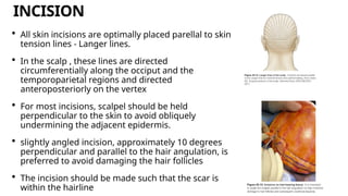 To My Incision Presentation on incisions and closures . | PPTX
