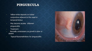 PINGUECULA
• Yellow-white deposits on bulbar
conjunctiva adjacent to the nasal or
temporal limbus
• May become acutely inf...