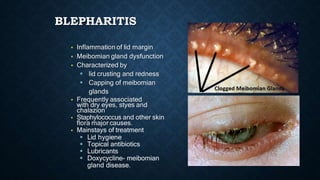 BLEPHARITIS
 Inflammation of lid margin
 Meibomian gland dysfunction
 Characterized by
 lid crusting and redness
 Cap...