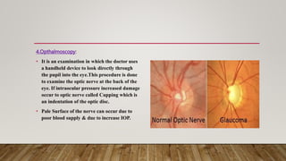4.Opthalmoscopy:
• It is an examination in which the doctor uses
a handheld device to look directly through
the pupil into the eye.This procedure is done
to examine the optic nerve at the back of the
eye. If intraocular pressure increased damage
occur to optic nerve called Cupping which is
an indentation of the optic disc.
• Pale Surface of the nerve can occur due to
poor blood supply & due to increase IOP.
 