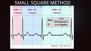 ECG Basics, and detailing individual waves | PPTX