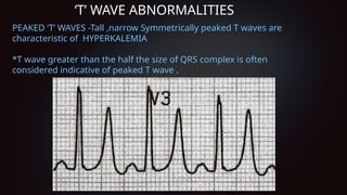 Peaked R Complex ECG Basics, and detailing individual waves | PPTX
