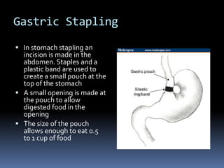 Gastric StaplingIn stomach stapling an incision is made in the abdomen. Staples and a plastic band are used to create a small pouch at the top of the stomachA small opening is made at the pouch to allow digested food in the openingThe size of the pouch allows enough to eat 0.5   to 1 cup of food