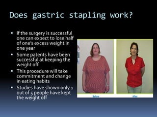 Does gastric stapling work?If the surgery is successful one can expect to lose half of one’s excess weight in one yearSome patents have been successful at keeping the weight offThis procedure will take commitment and change in eating habitsStudies have shown only 1 out of 5 people have kept the weight off