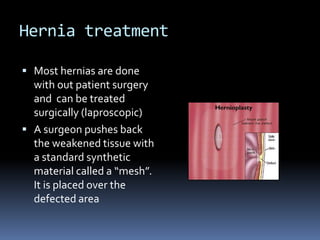 Hernia treatmentMost hernias are done with out patient surgery and  can be treated surgically (laproscopic) A surgeon pushes back the weakened tissue with a standard synthetic material called a “mesh”. It is placed over the defected area 