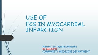 USE OF
ECG IN MYOCARDIAL
INFARCTION
Mentor : Dr. Ayasha Shrestha
BY GROUP D
COMMUNITY MEDICINE DEPARTMENT
 