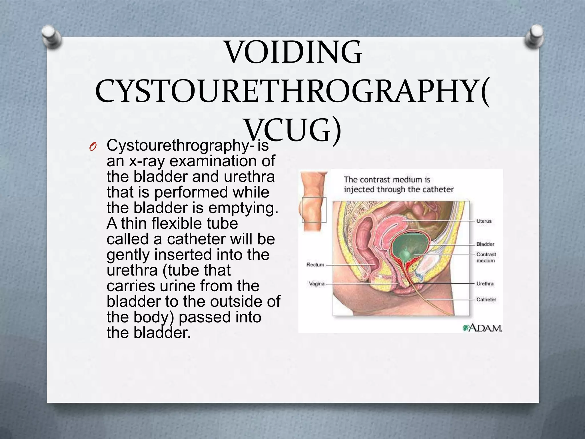 VOIDING CYSTOURETHROGRAPHY( VCUG)Cystourethrography- is an x-ray examination of the bladder and urethra that is performed while the bladder is emptying. A thin flexible tube called a catheter will be gently inserted into the urethra (tube that carries urine from the bladder to the outside of the body) passed into the bladder.