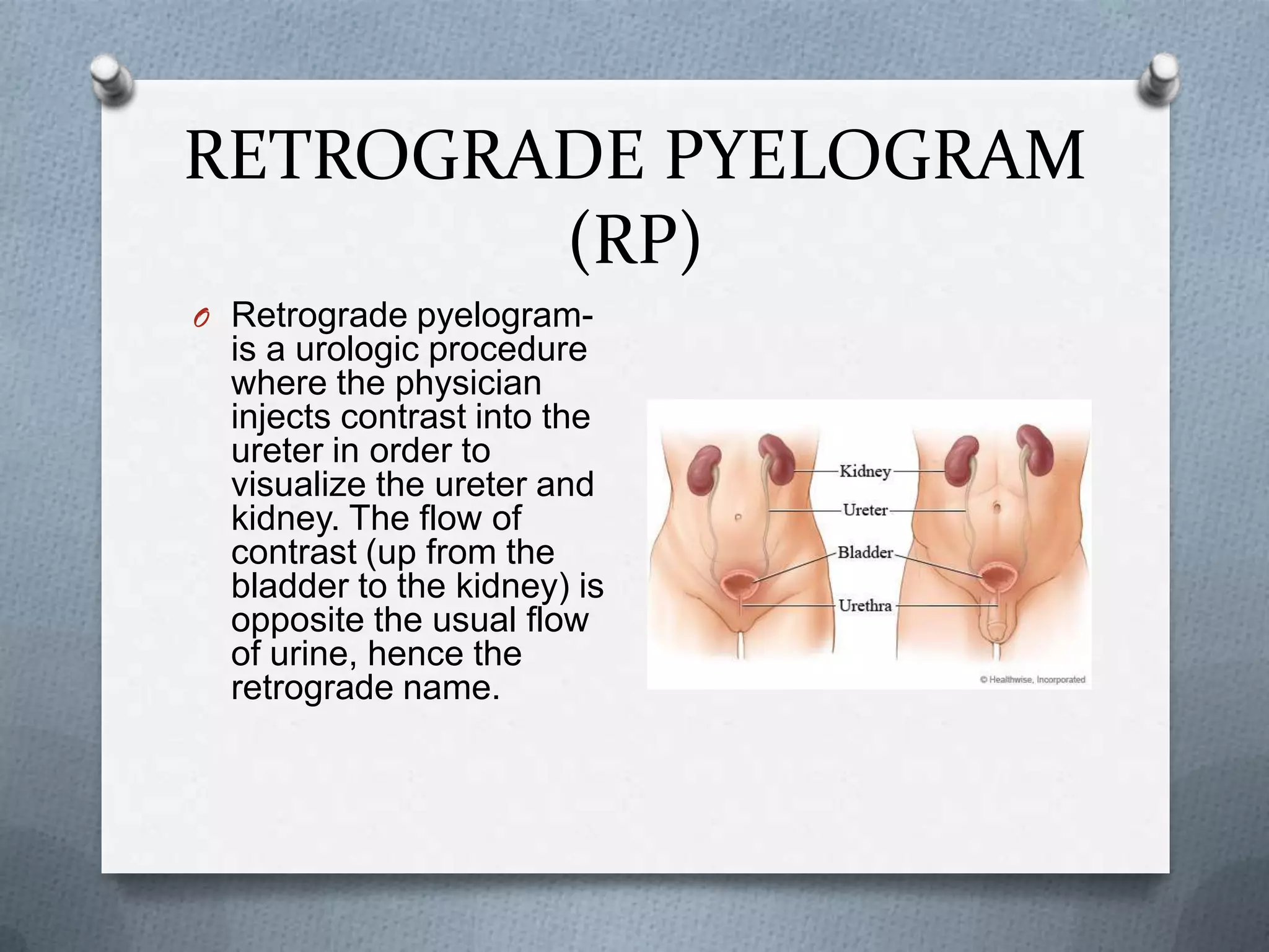 RETROGRADE PYELOGRAM (RP)Retrograde pyelogram- is a urologic procedure where the physician injects contrast into the ureter in order to visualize the ureter and kidney. The flow of contrast (up from the bladder to the kidney) is opposite the usual flow of urine, hence the retrograde name.