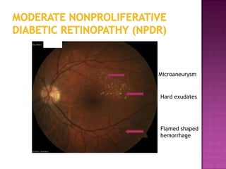 Microaneurysm



Hard exudates




Flamed shaped
hemorrhage
 