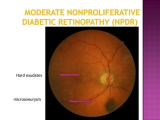 Hard exudates




microaneurysm
 