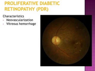 Characteristics
• Neovascularization
• Vitreous hemorrhage
 