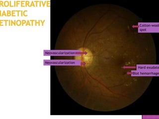 Cotton-wool
                        spot




Neovascularization

Neovascularization
                        Hard exudate
                     Blot hemorrhage
 