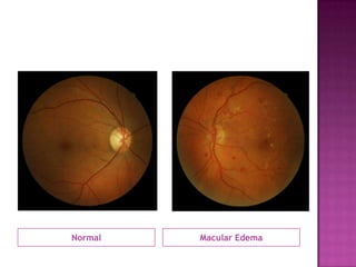 Normal   Macular Edema
 