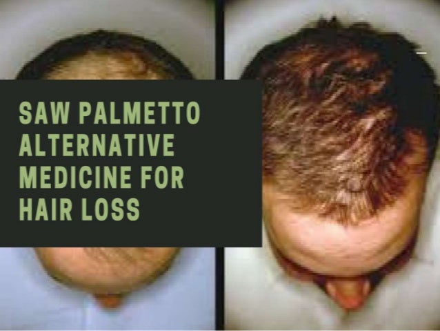 Palmetto hair is saw what loss for Saw Palmetto