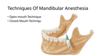 Mandibular Anesthesia and Inferior Alveolar Nerve Block Techniques | PPTX