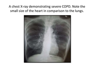 A chest X-ray demonstrating severe COPD. Note the
small size of the heart in comparison to the lungs.
 