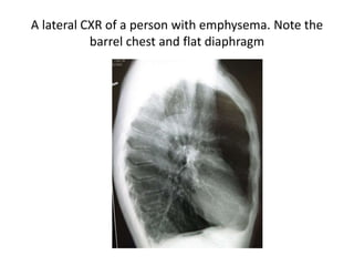 A lateral CXR of a person with emphysema. Note the
barrel chest and flat diaphragm
 