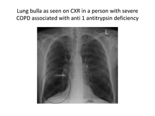 Lung bulla as seen on CXR in a person with severe
COPD associated with anti 1 antitrypsin deficiency
 