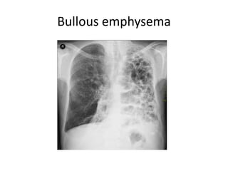 Bullous emphysema
 