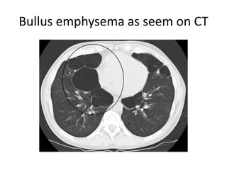 Bullus emphysema as seem on CT
 