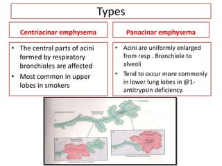 Types
Centriacinar emphysema
• The central parts of acini
formed by respiratory
bronchioles are affected
• Most common in upper
lobes in smokers
Panacinar emphysema
• Acini are uniformly enlarged
from resp . Bronchiole to
alveoli
• Tend to occur more commonly
in lower lung lobes in @1-
antitrypsin deficiency.
 