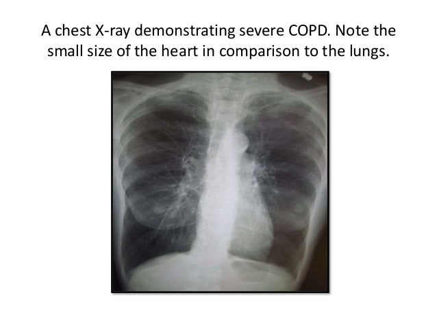 Emphysema