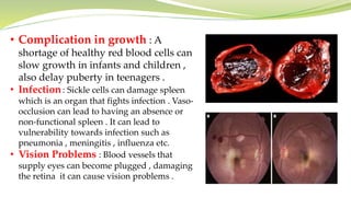 • Complication in growth : A
shortage of healthy red blood cells can
slow growth in infants and children ,
also delay puberty in teenagers .
• Infection : Sickle cells can damage spleen
which is an organ that fights infection . Vaso-
occlusion can lead to having an absence or
non-functional spleen . It can lead to
vulnerability towards infection such as
pneumonia , meningitis , influenza etc.
• Vision Problems : Blood vessels that
supply eyes can become plugged , damaging
the retina it can cause vision problems .
 