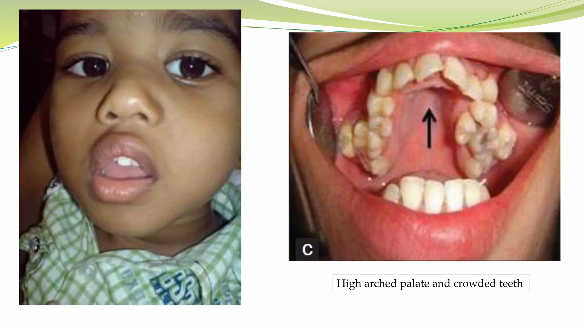 High arched palate and crowded teeth
 