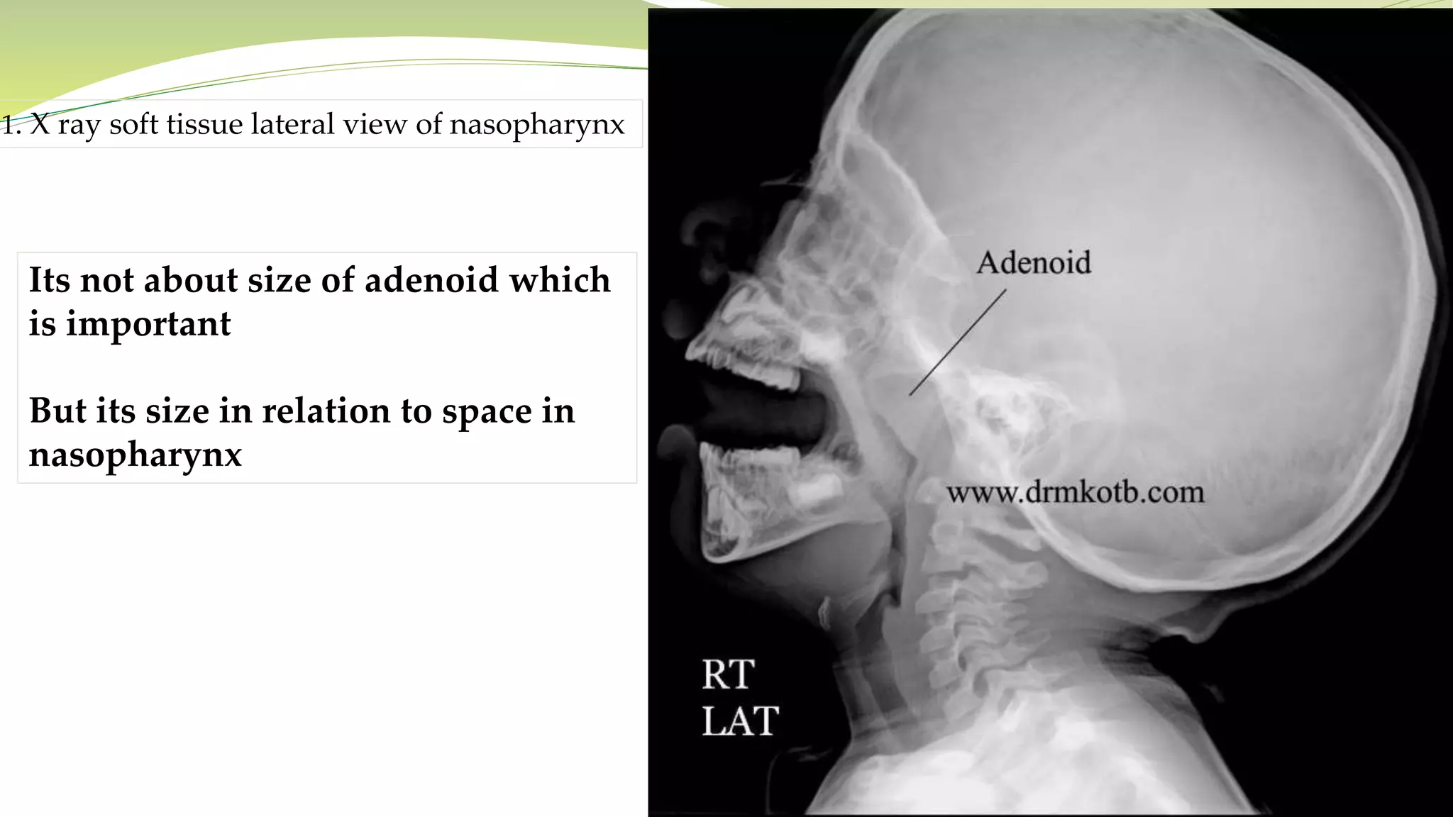 1. X ray soft tissue lateral view of nasopharynx
Its not about size of adenoid which
is important
But its size in relation to space in
nasopharynx
 