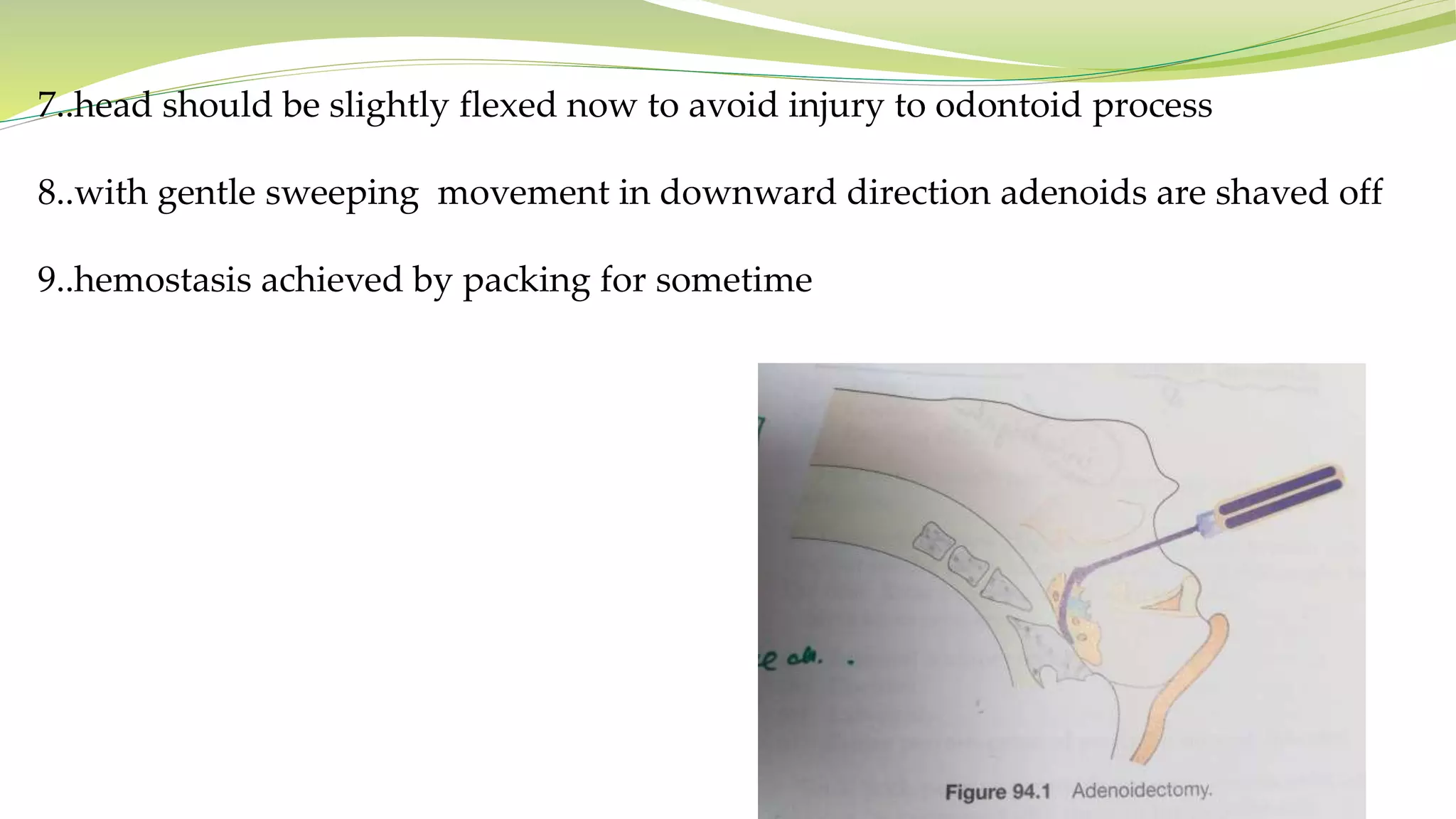 7..head should be slightly flexed now to avoid injury to odontoid process
8..with gentle sweeping movement in downward direction adenoids are shaved off
9..hemostasis achieved by packing for sometime
 