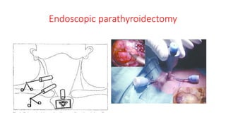 Endoscopic parathyroidectomy
 