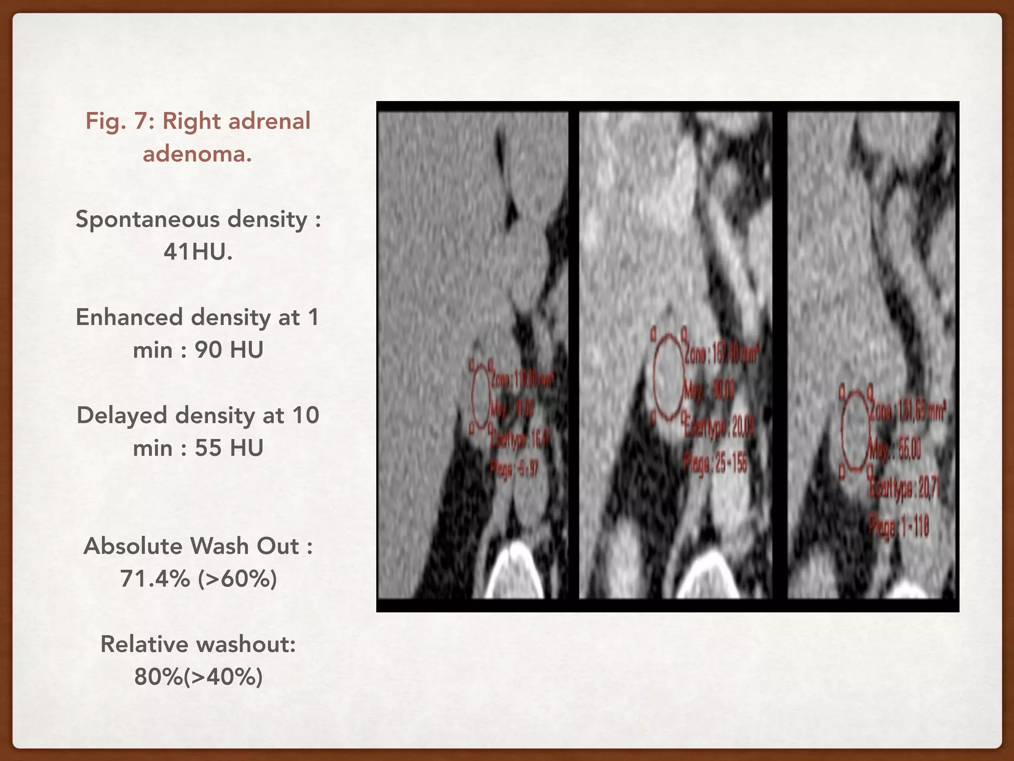 Fig. 7: Right adrenal
adenoma.
Spontaneous density :
41HU.
Enhanced density at 1
min : 90 HU
Delayed density at 10
min : 55 HU
Absolute Wash Out :
71.4% (>60%)
Relative washout:
80%(>40%)
 