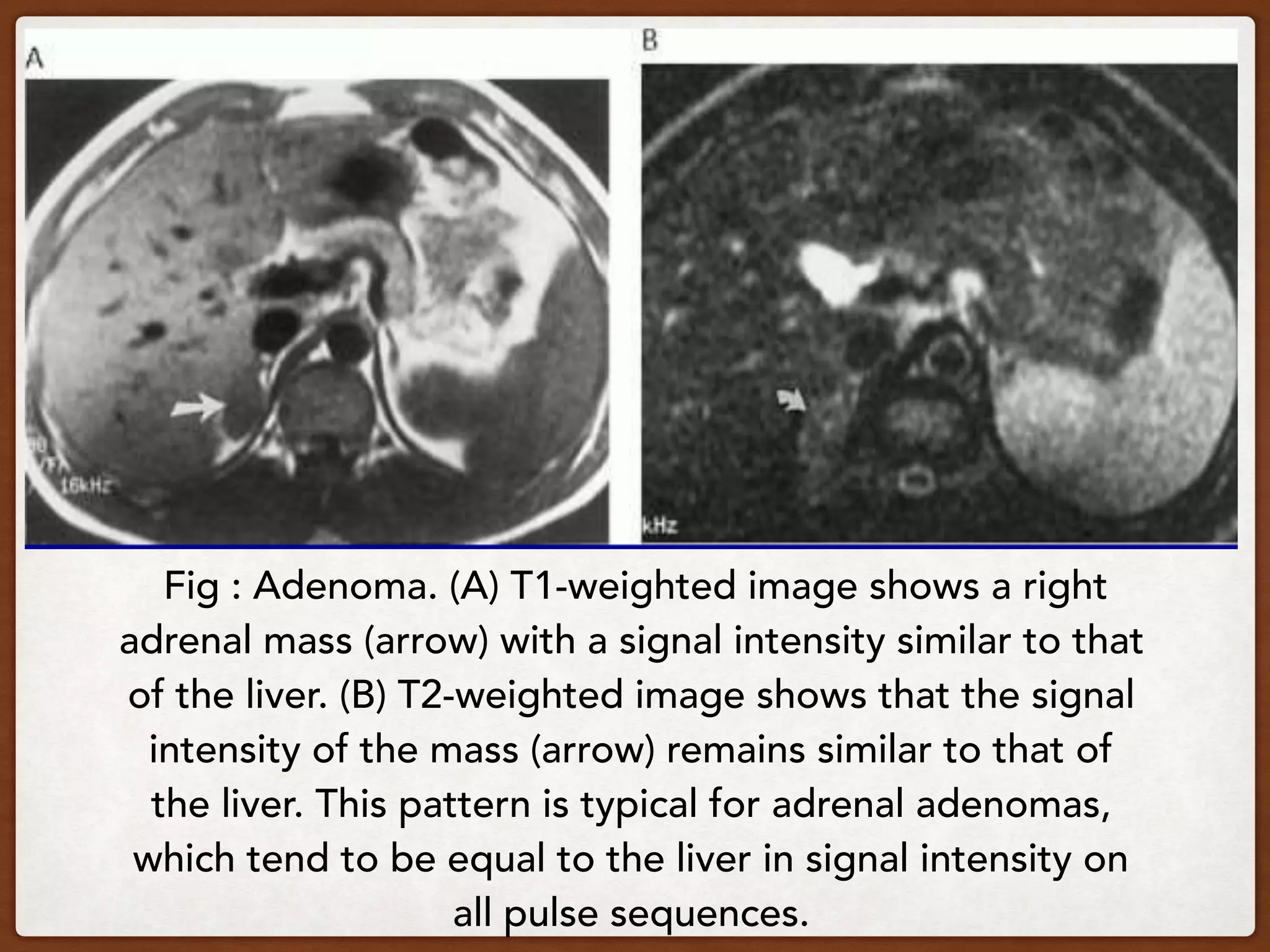Fig : Adenoma. (A) T1-weighted image shows a right
adrenal mass (arrow) with a signal intensity similar to that
of the liver. (B) T2-weighted image shows that the signal
intensity of the mass (arrow) remains similar to that of
the liver. This pattern is typical for adrenal adenomas,
which tend to be equal to the liver in signal intensity on
all pulse sequences.
 