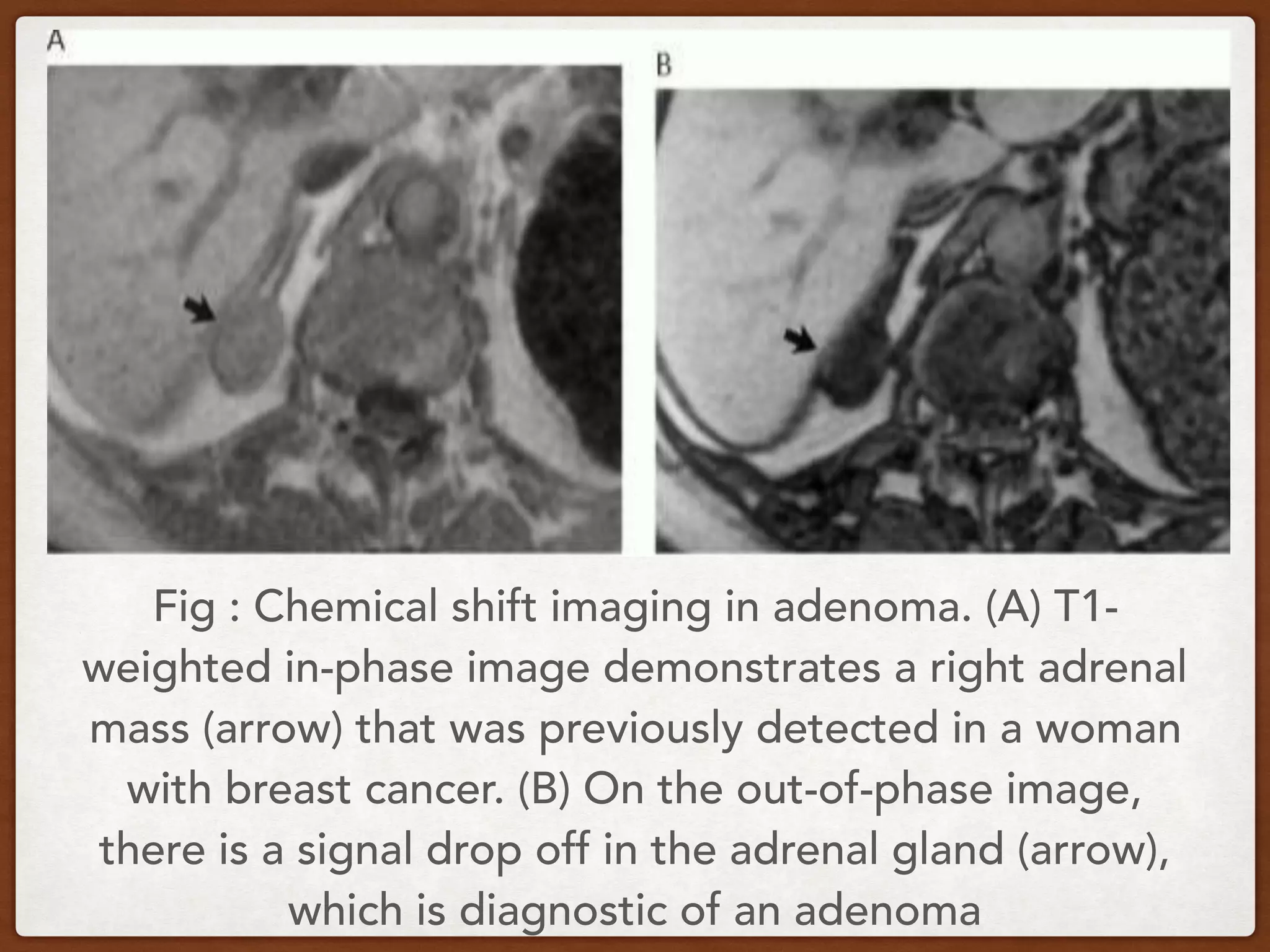 Fig : Chemical shift imaging in adenoma. (A) T1-
weighted in-phase image demonstrates a right adrenal
mass (arrow) that was previously detected in a woman
with breast cancer. (B) On the out-of-phase image,
there is a signal drop off in the adrenal gland (arrow),
which is diagnostic of an adenoma
 