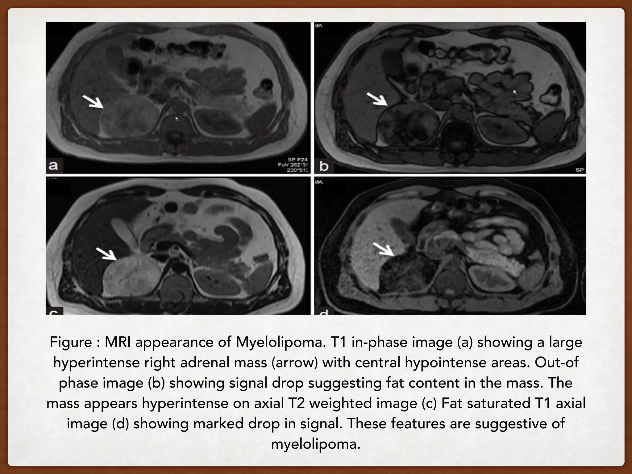 Figure : MRI appearance of Myelolipoma. T1 in-phase image (a) showing a large
hyperintense right adrenal mass (arrow) with central hypointense areas. Out-of
phase image (b) showing signal drop suggesting fat content in the mass. The
mass appears hyperintense on axial T2 weighted image (c) Fat saturated T1 axial
image (d) showing marked drop in signal. These features are suggestive of
myelolipoma.
 