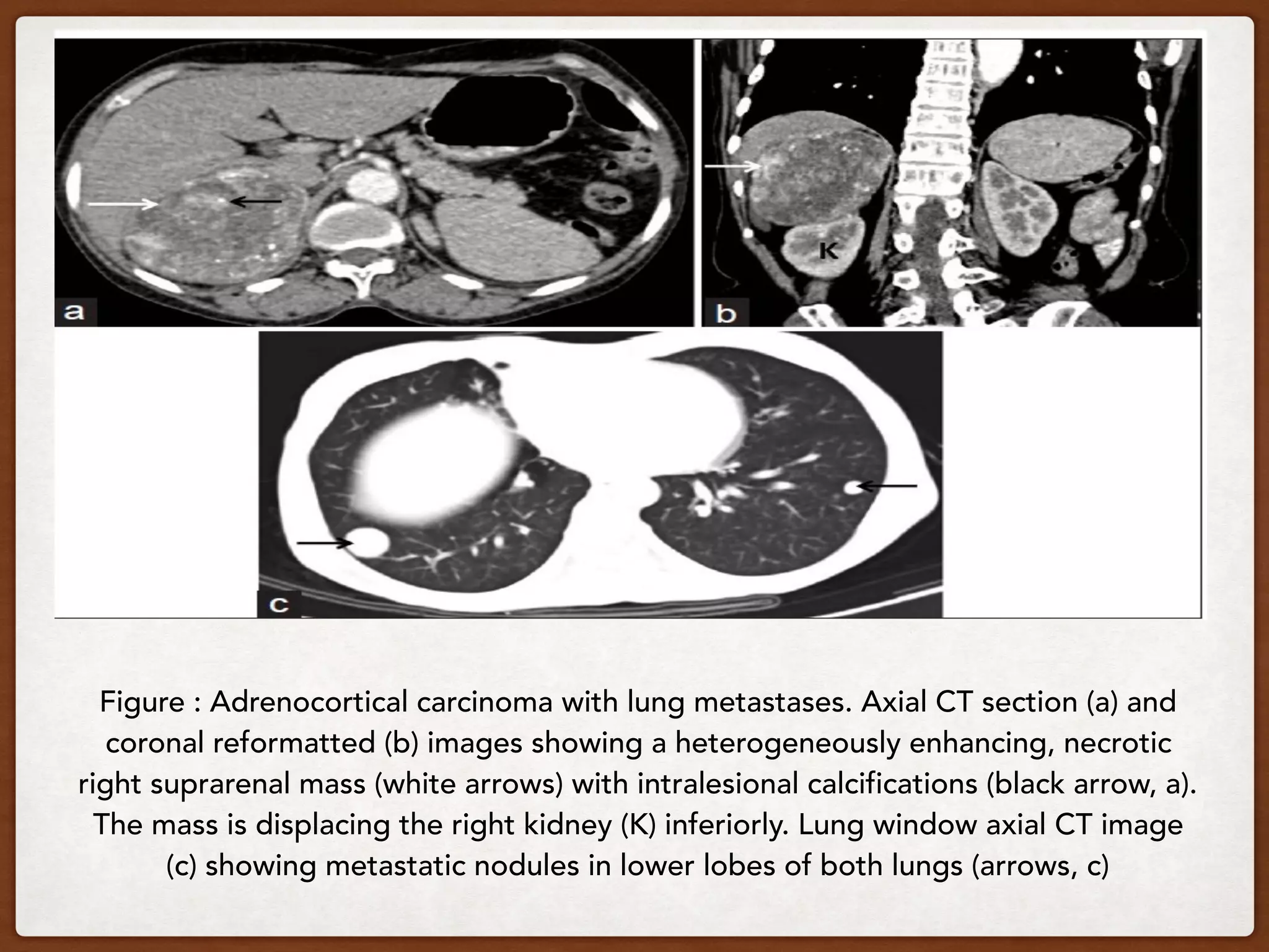 Figure : Adrenocortical carcinoma with lung metastases. Axial CT section (a) and
coronal reformatted (b) images showing a heterogeneously enhancing, necrotic
right suprarenal mass (white arrows) with intralesional calcifications (black arrow, a).
The mass is displacing the right kidney (K) inferiorly. Lung window axial CT image
(c) showing metastatic nodules in lower lobes of both lungs (arrows, c)
 