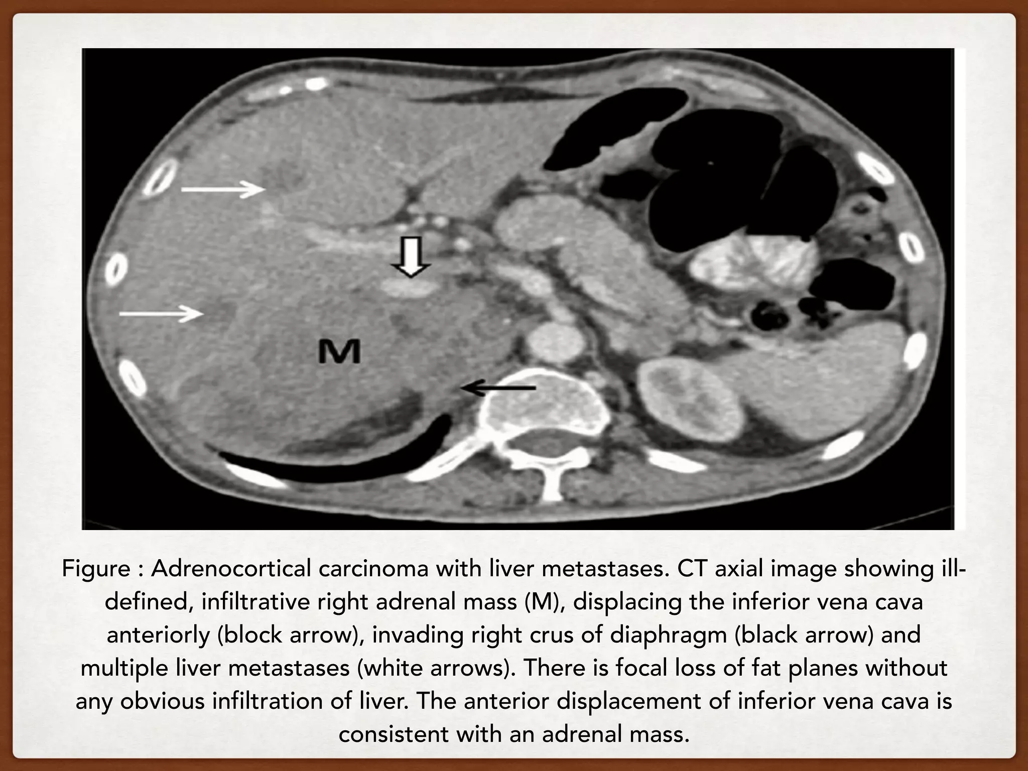 Figure : Adrenocortical carcinoma with liver metastases. CT axial image showing ill-
defined, infiltrative right adrenal mass (M), displacing the inferior vena cava
anteriorly (block arrow), invading right crus of diaphragm (black arrow) and
multiple liver metastases (white arrows). There is focal loss of fat planes without
any obvious infiltration of liver. The anterior displacement of inferior vena cava is
consistent with an adrenal mass.
 