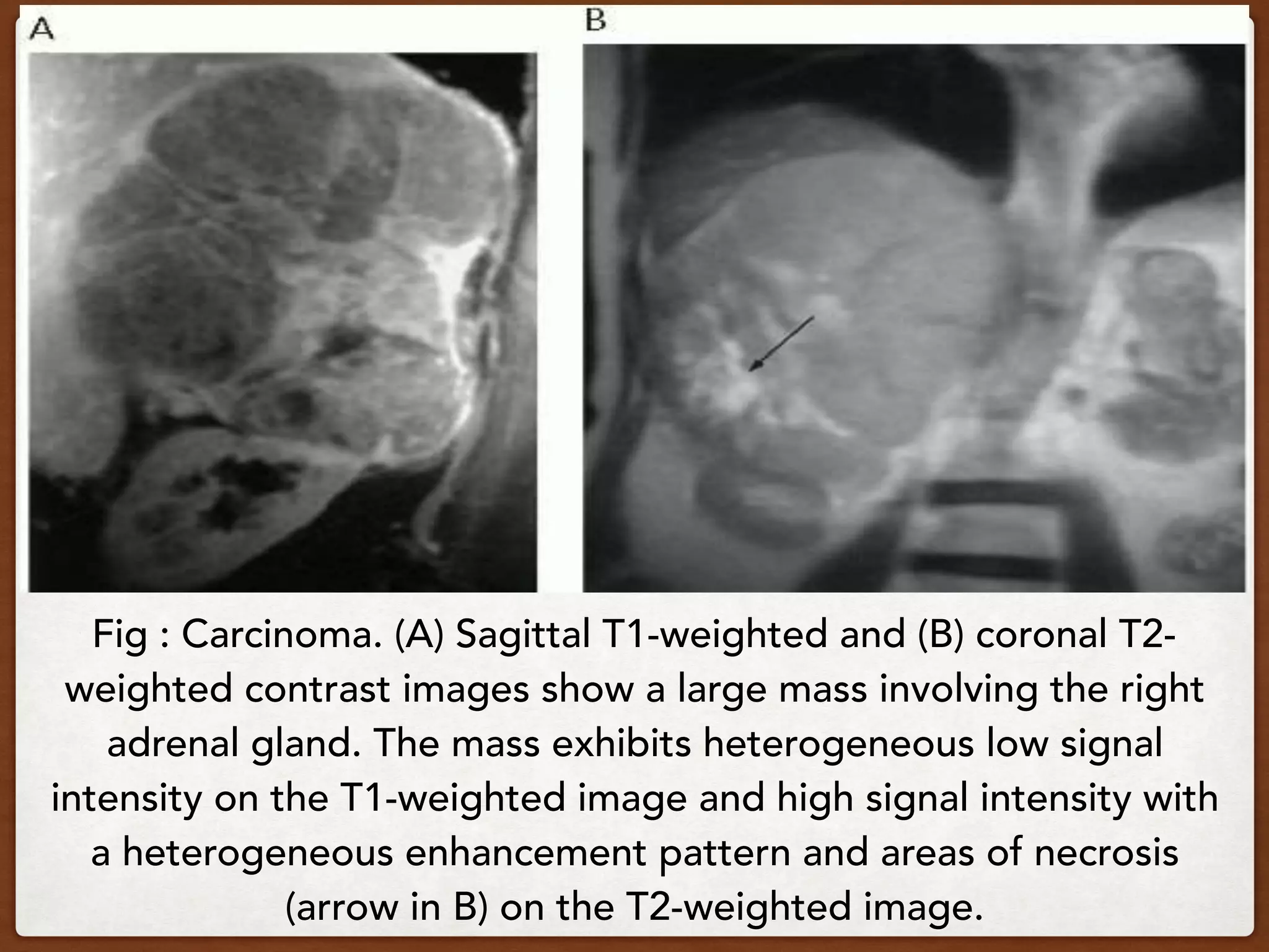 Fig : Carcinoma. (A) Sagittal T1-weighted and (B) coronal T2-
weighted contrast images show a large mass involving the right
adrenal gland. The mass exhibits heterogeneous low signal
intensity on the T1-weighted image and high signal intensity with
a heterogeneous enhancement pattern and areas of necrosis
(arrow in B) on the T2-weighted image.
 
